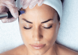 micro needling central coast